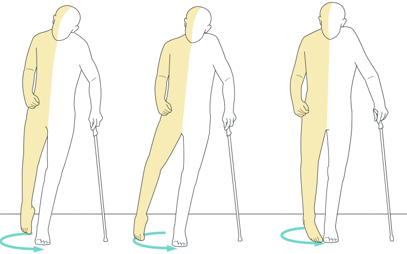 Foot Drop Adalah Penyulit Kaki Untuk Melangkah atau Berjalan