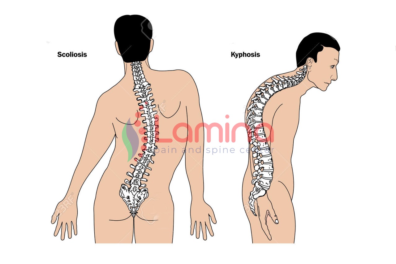 Kifosis Adalah Kelainan Pada Tulang Belakang yang Membungkuk