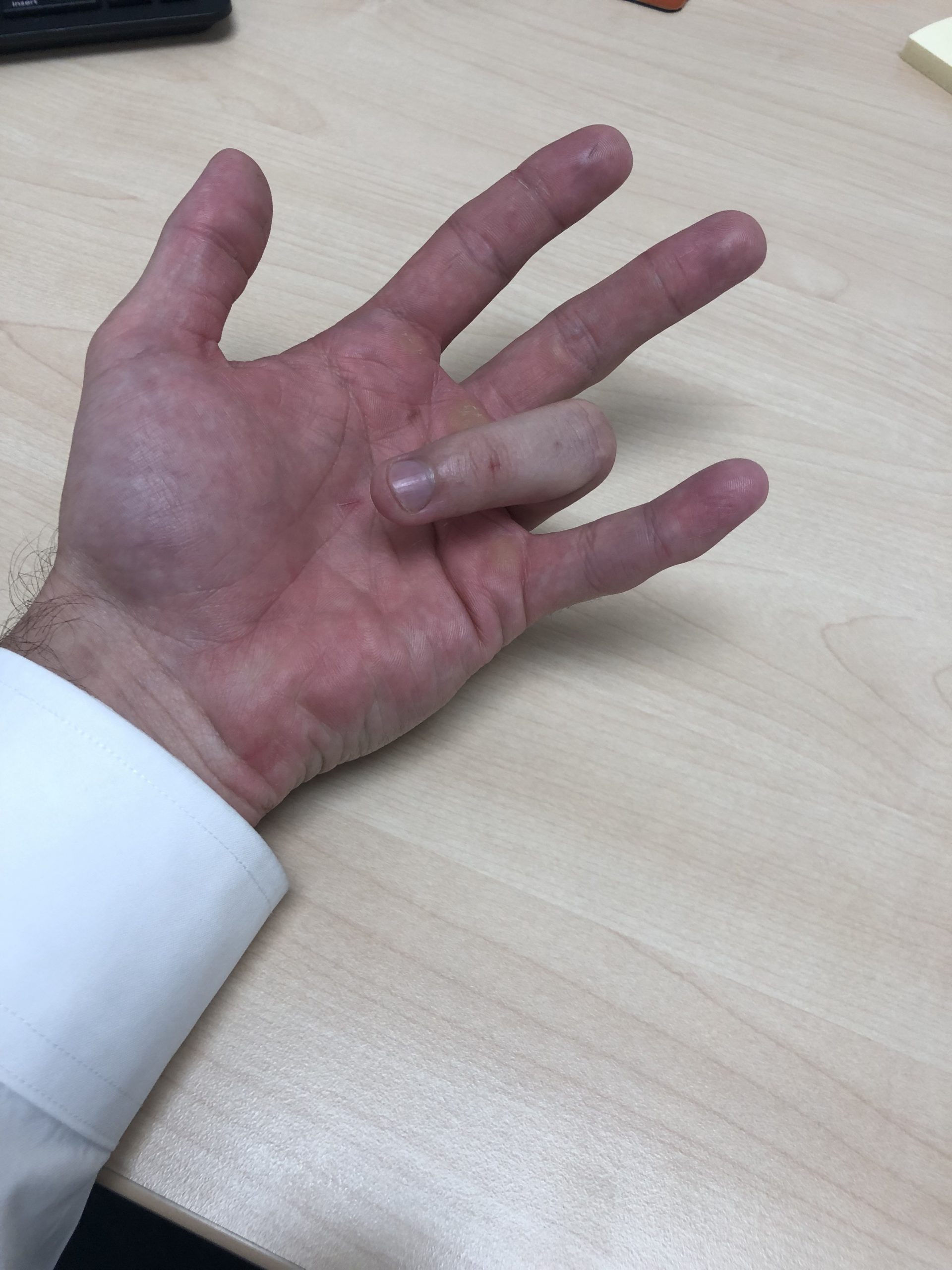 Trigger Finger Seringnya Mengenai Perempuan?