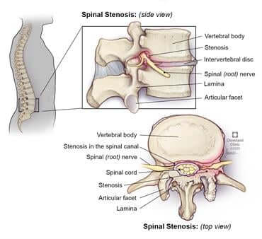 Mengenal Stenosis Spinal, Penyebab, Gejala, Pencegahan