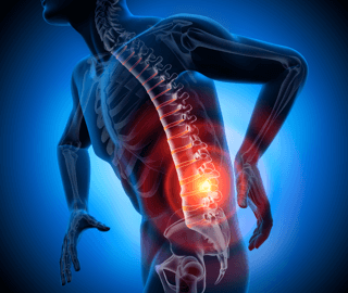 Terapi Laser PLDD Pada Masalah Saraf Kejepit Tulang Belakang